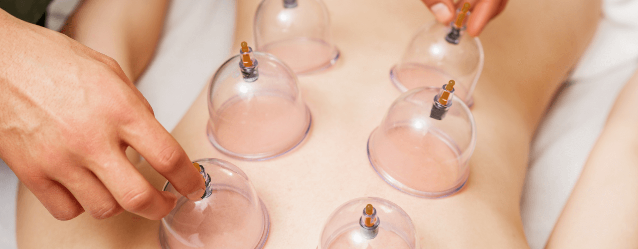 Therapeutic Cupping Therapy Evanston and Northbrook, IL