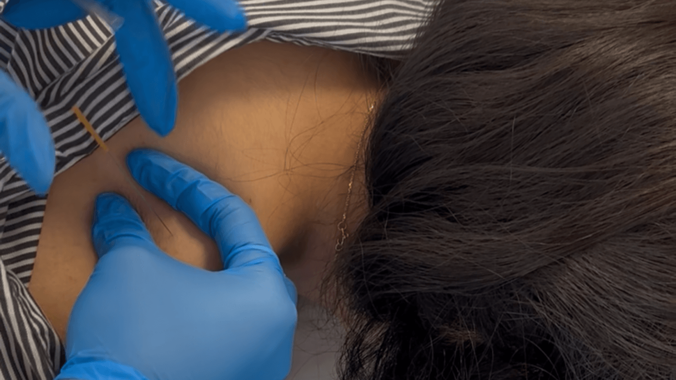Close-up of a physical therapist performing dry needling near the shoulder