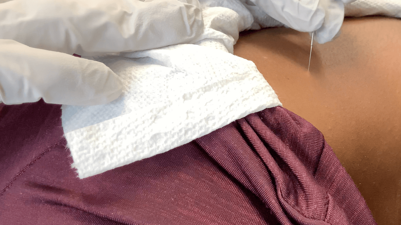 Close-up of a gloved physical therapist performing dry needling