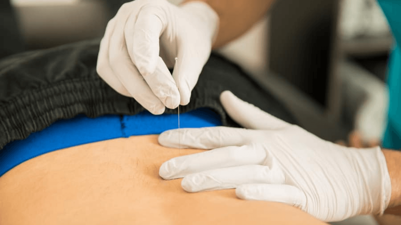 Physical therapist performing dry needling around the lower back or hip